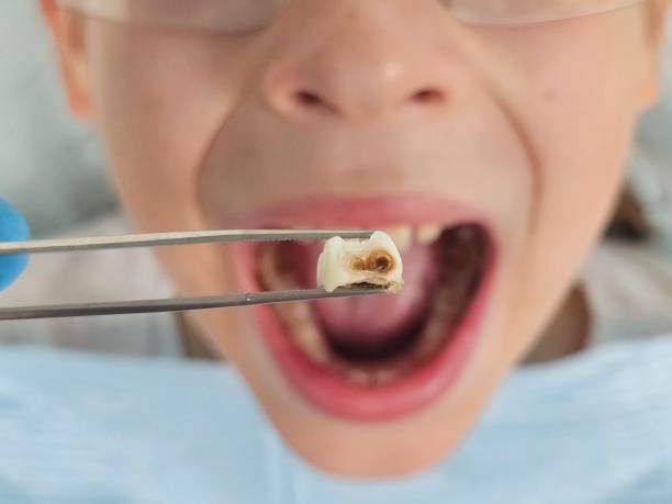 Best Emergency Root Canal Treatment in Greenville, SC